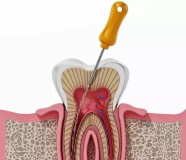 Kanal Tedavisi - Endodonti Görseli